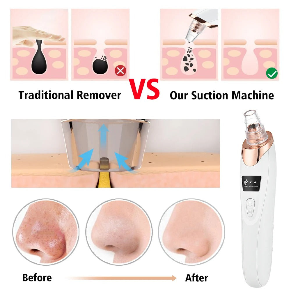 Suction Mode Blackhead Remover