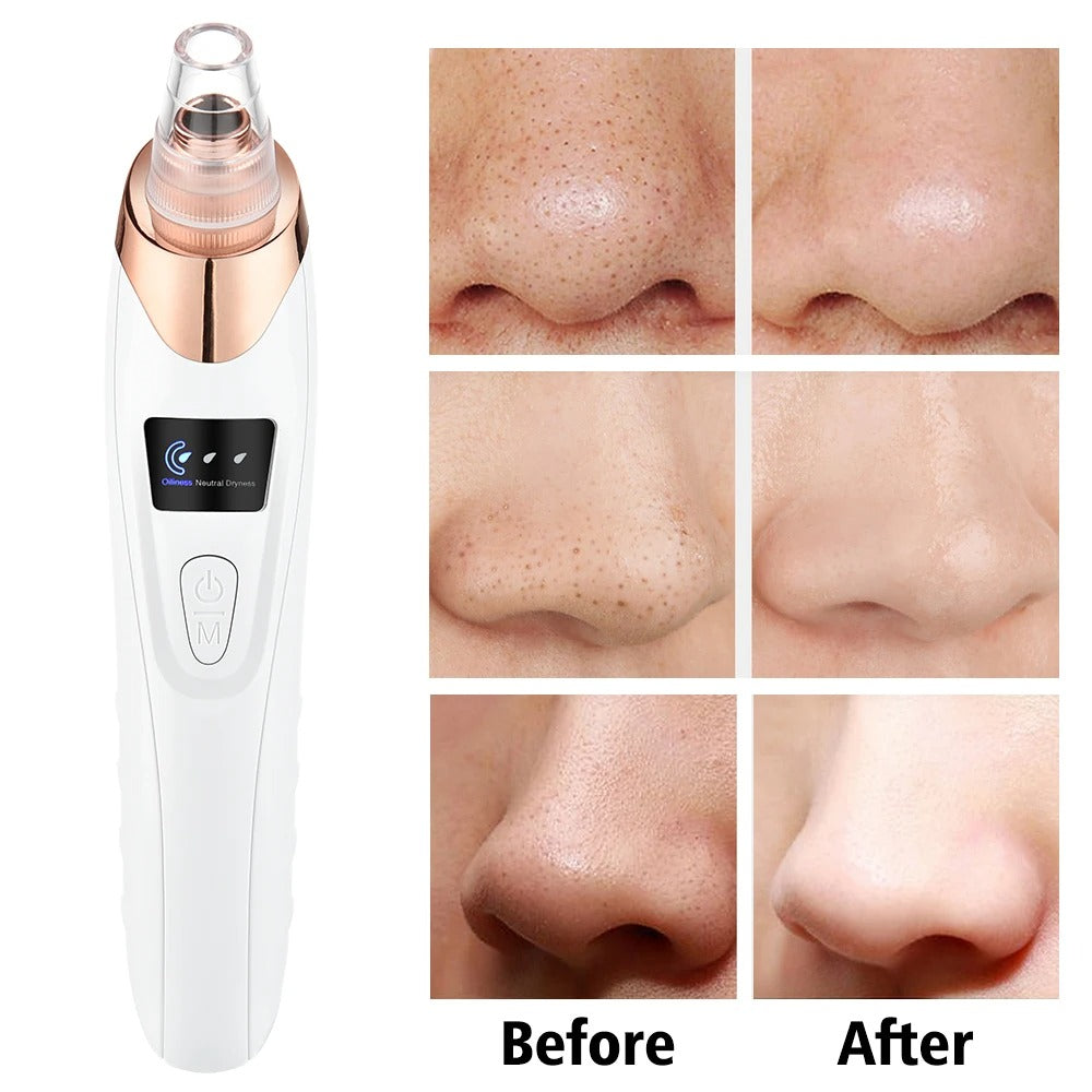 Suction Mode Blackhead Remover